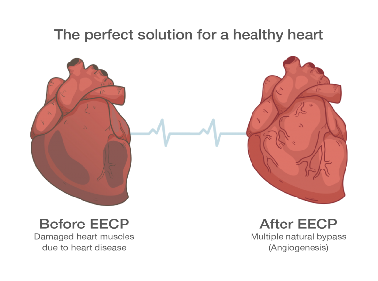 The perfect solution for a health heart by EECP Therapy